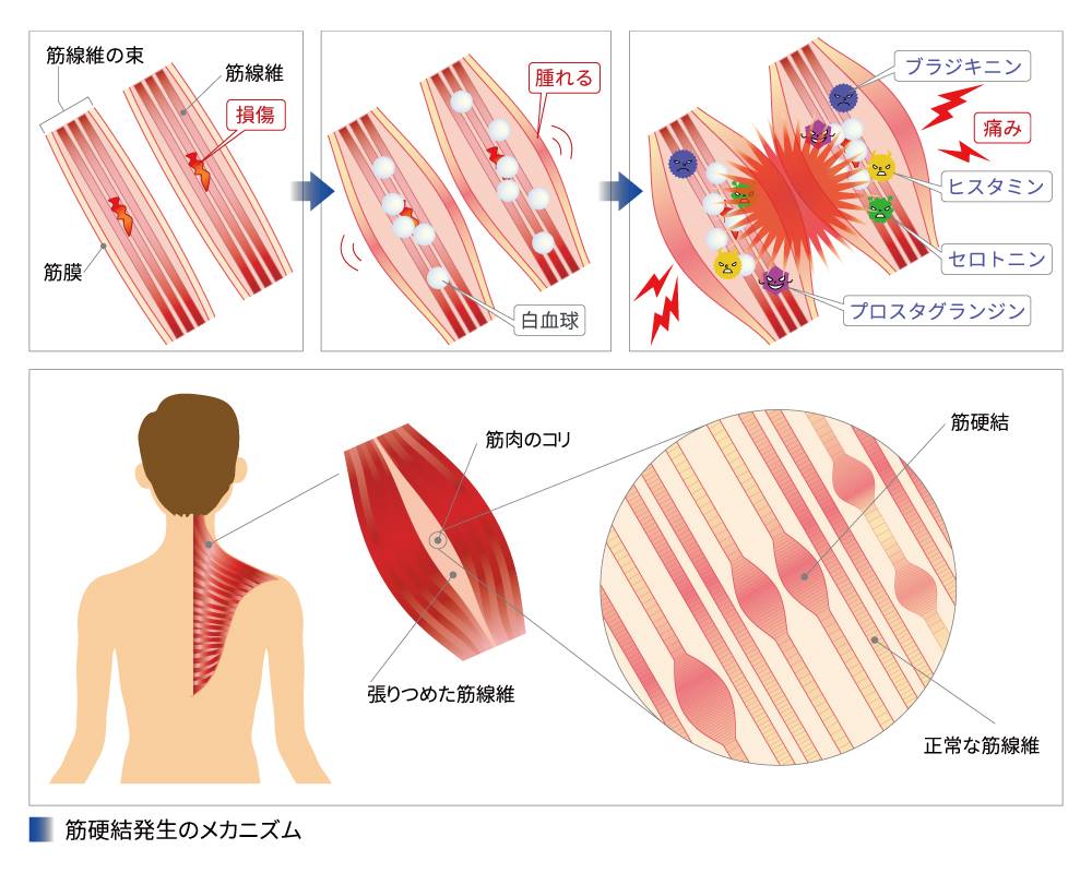 硬結メルト手技 いとひや整骨院 千葉市おゆみ野 鎌取